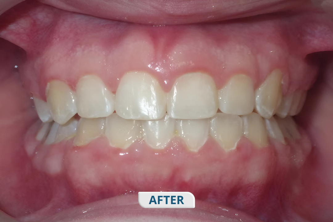 After treatment at Namira Oro Dental Care